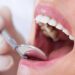 Grávida pode fazer tratamento dentário