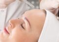 Melasma na gravidez: como tratar?
